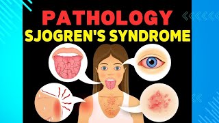 24 Sjogren Syndrome and Scleroderma [upl. by Teloiv475]