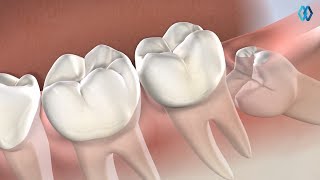 Wisdom Teeth Removal at North Jersey Oral amp Maxillofacial Surgery Teaneck NJ [upl. by Ender]