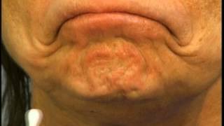 Instructions for Using Botox in the Chin by Dr Elliott of Skinspirations [upl. by Tova115]