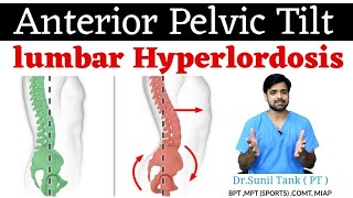 correction exercises for lumbar hyperlordosis anterior pelvic tilt  in hindi  Physiopoint [upl. by Acinok205]