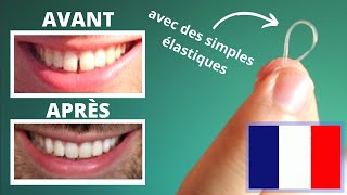 Réduire lécart entre les Dents Du Bonheur en 40 JOURS SANS appareil dentaire [upl. by Prosperus]