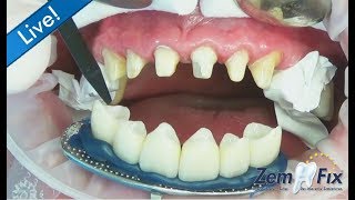 ZemFix®  inserting 6 allceramic zirconia crowns in the upper front [upl. by Akerue178]