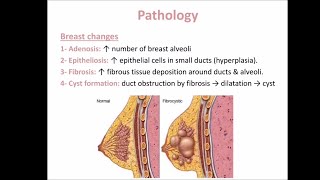 Fibroadenosis [upl. by Flori]