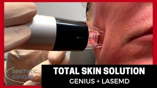 Total Skin Solution  Genius  LaseMD [upl. by Etolas830]