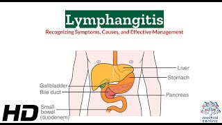 Lymphangitis 101 A Comprehensive Guide to Symptoms and Effects [upl. by Buzzell]