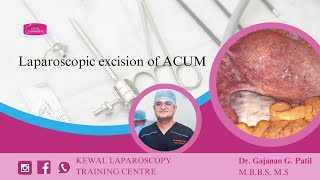 Laparoscopic excision of ACUM Kewal Hospital  Laparoscopy Training [upl. by Aduh]