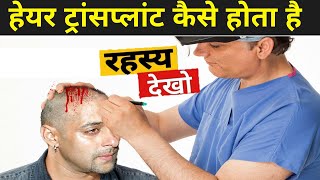 Hair Transplant कैसे किया जाता है   Hair Transplant Kaise Hota Hai Hindi Me [upl. by Ortiz]