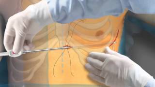 New implanted defibrillator works well without touching heart [upl. by Alletniuq]