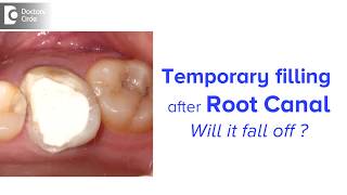 How long can you keep a temporary filling after root canal  Dr Chandan Mahesh [upl. by Simonetta615]