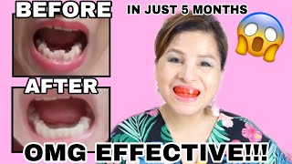 HOW I STRAIGHTEN MY TEETH in 5 MONTHS WITHOUT USING BRACES MYOBRACE REVIEW  Bella Concepcion [upl. by Weingarten81]