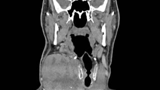 Anaplastic Thyroid Carcinoma [upl. by Sandry]