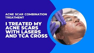 I TREATED MY ACNE SCARS WITH LASERS AND TCA CROSS  ACNE SCAR COMBINATION TREATMENT  Dr Jason Emer [upl. by Durno1]