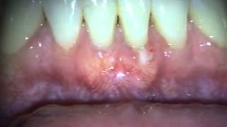 Periodontal Microsurgery AlloDerm Grafting Lower Anterior [upl. by Yelsnia181]