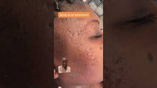 Atrophic Scar Treatment with Dermal Fillers blackskincare [upl. by Otit]