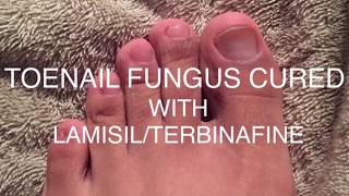 Toenail Fungus BeforeAfter  LamisilTerbinafine 2019 [upl. by Lamiv]