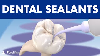 How to PREVENT CAVITIES  Dental sealants © [upl. by Annasiul]