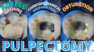 Access Opening 🟡 Chemomechanical Preparation 🟣 Obturation ⚪️ Pulpectomy [upl. by Aihsal879]