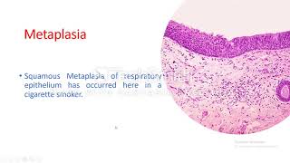 Cellular adaptation Metaplasia [upl. by Gnud]