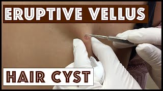 Unusual types of Cysts Eruptive Vellus Hair Cysts Part 1 in a Series [upl. by Luanne]