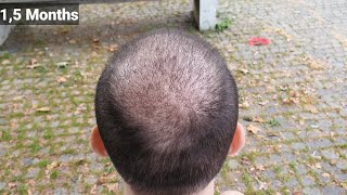 FUE Hair Transplant Timeline I Day 1 to Day 365 I Before amp After [upl. by Chae]