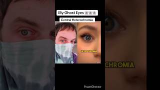 Central Heterochromia Doctors Opinion [upl. by Niuqram]