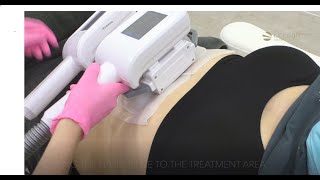 Fat Freezing treatment before and after with Dr Leah [upl. by Centonze]