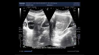 A large Fibroid and two ovarian Cysts [upl. by Inig]