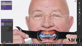 Same day digital denture [upl. by Suter]