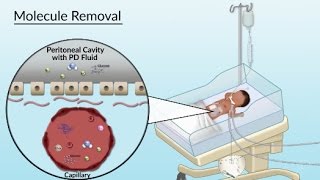 Peritoneal Dialysis by S Su A Olszewski  OPENPediatrics [upl. by Yoshio36]