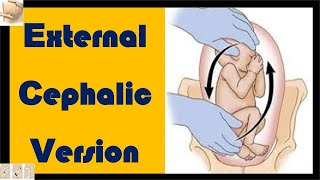 External Cephalic Version ECV  How to Flip a Fetus  How to Turn a Breech Baby [upl. by Livingstone]