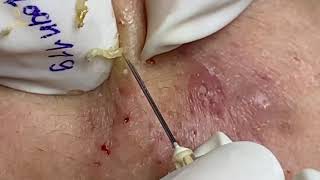 BEST BLACKHEADS EXTRACTION 119  Loan Nguyen [upl. by Gnihc]