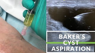 Simple Bakers Cyst Aspiration [upl. by Cyprus]