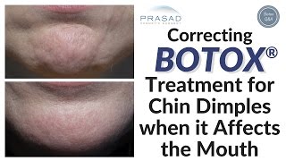 How Placement of Botox® in the Chin May Affect the Lips and Mouth [upl. by Herold281]