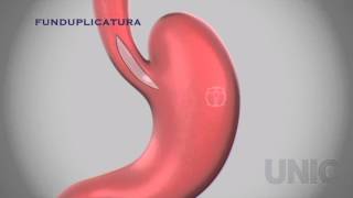 Tratamiento quirúrgico para la Acalasia Miotomía de Heller más Funduplicatura tipo Dor [upl. by Zanze319]