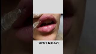 How to Fill In Your Lips  Lip Filler Injection [upl. by Nalyd]