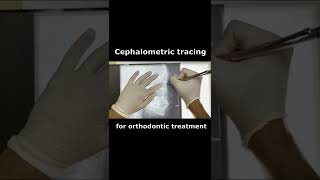 OrthodonticsCephalometric tracing│矯正治療のセファロのトレースshorts [upl. by Acirretahs]