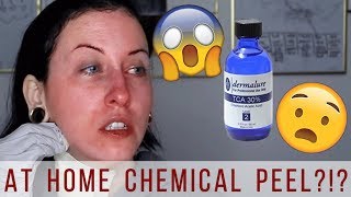 How to Do a TCA Peel at Home  TCA 30 Chemical Peel  Before amp After Results [upl. by Cosette]