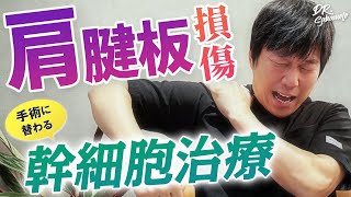 【再生医療】肩腱板損傷の治療法！手術に変わる幹細胞治療という新しい選択肢【医師が解説】 [upl. by Odnalref]