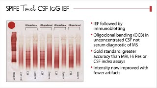 Oligoclonal Banding Assay Diagnosing Multiple Sclerosis [upl. by Burch]