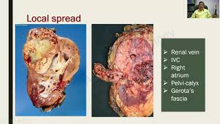 Renal Cell Carcinoma and Wilms Tumor  Renal Pathology  RATS in Pathology [upl. by Acirt177]