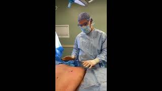 SAFE Liposuction High BMI Patient [upl. by Elik]