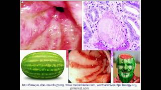 Histopathology  Gastric Antral Vascular ectasia GAVE [upl. by Azar]