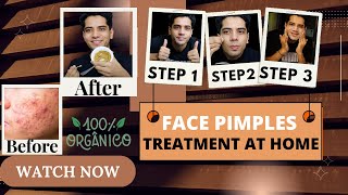 Face Pimples Treatment At Home  ACNE TREATMENT  Pimples Kese Hataye  shivammalik [upl. by Teri169]