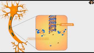 Alzheimers disease Pathophysiology Amyloid plaques and Tau tangles Risk Factors Treatment [upl. by Bronny785]