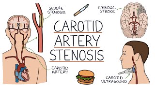 Understanding Carotid Artery Stenosis [upl. by Nordgren461]