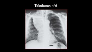 interprétation radiologique type atélectasie [upl. by Hillier]