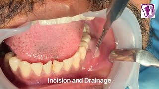 Incision and Drainage of Tooth Abscess Draining Pus [upl. by Nylinnej]