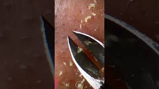 Skincare  Blackheads Removal 243 tweezers skincare blackheads blackheads [upl. by Hayne]