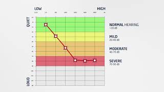 Hearcom  How to Read an Audiogram [upl. by Yup]