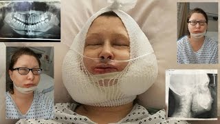 Jaw Surgery Day Vlog  Recovery day 130 [upl. by Moreno898]